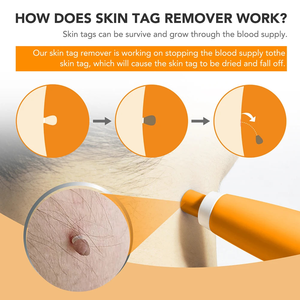 Skin Tag Removal Device Face Beauty Accessories Rubber Rings Wart Tag Remover Kit Multipurpose Supplies for Face Neck Chin Back