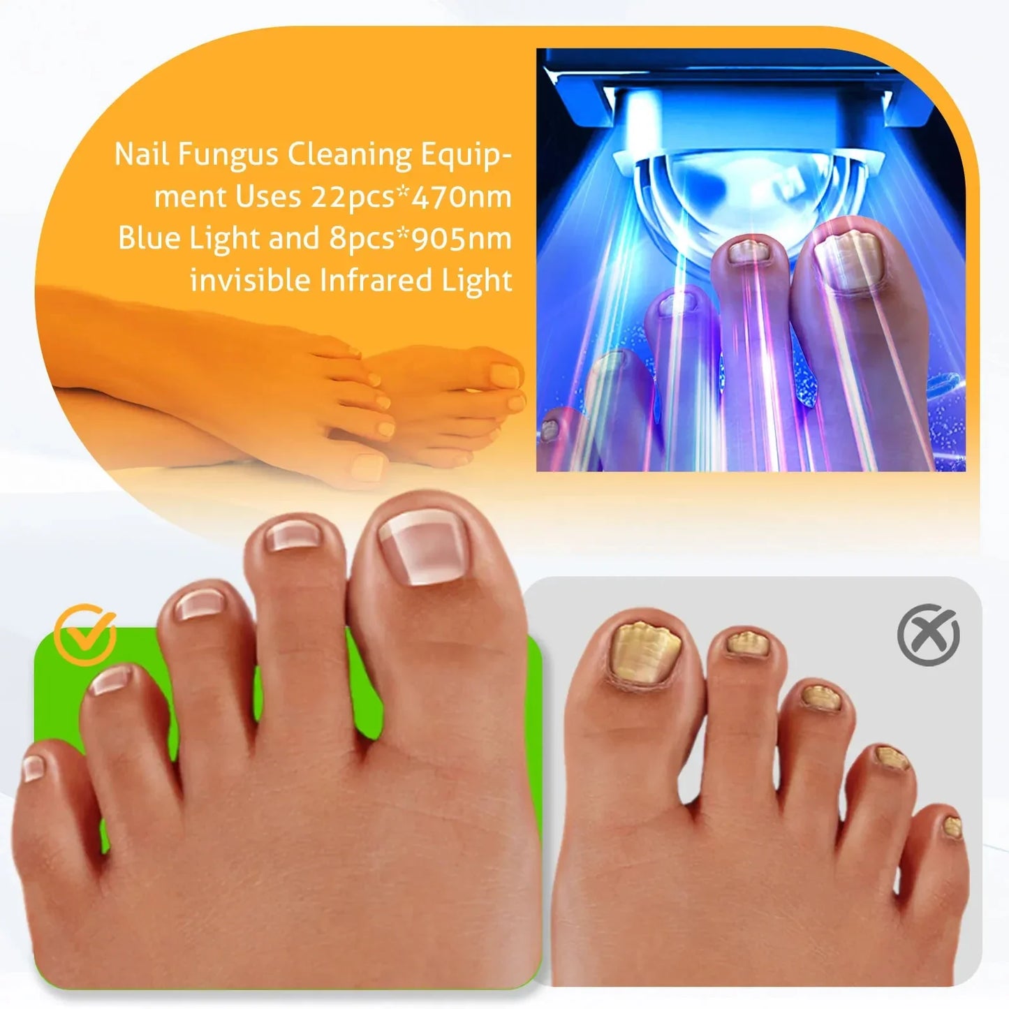 Nail Fungus Laser Treatment Device Fingernail Fungus Treat Onychomycosis Therapy Effectively Remove Onychomycosis Grow Toe Nail